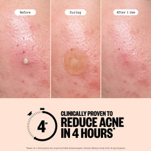 Load image into Gallery viewer, Acne Treatment Dots
