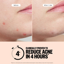 Load image into Gallery viewer, Acne Treatment Dots
