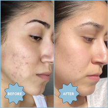 Load image into Gallery viewer, Meltdown Acne Oil | Blume - Pothos Beauty
