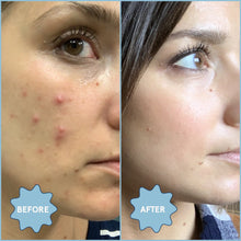 Load image into Gallery viewer, Meltdown Acne Oil | Blume - Pothos Beauty
