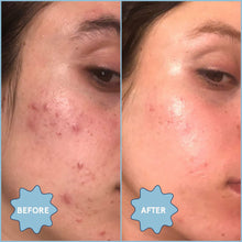 Load image into Gallery viewer, Meltdown Acne Oil | Blume - Pothos Beauty
